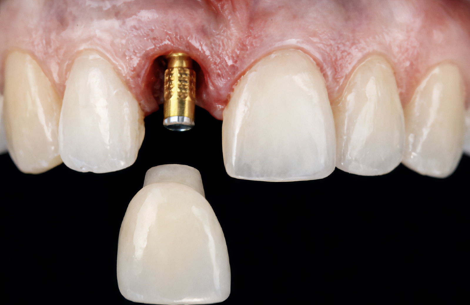 Maryland Bridge vs Implant: Single Tooth Replacement Options | by Andrew Sedler | Burbank Dental Lab
