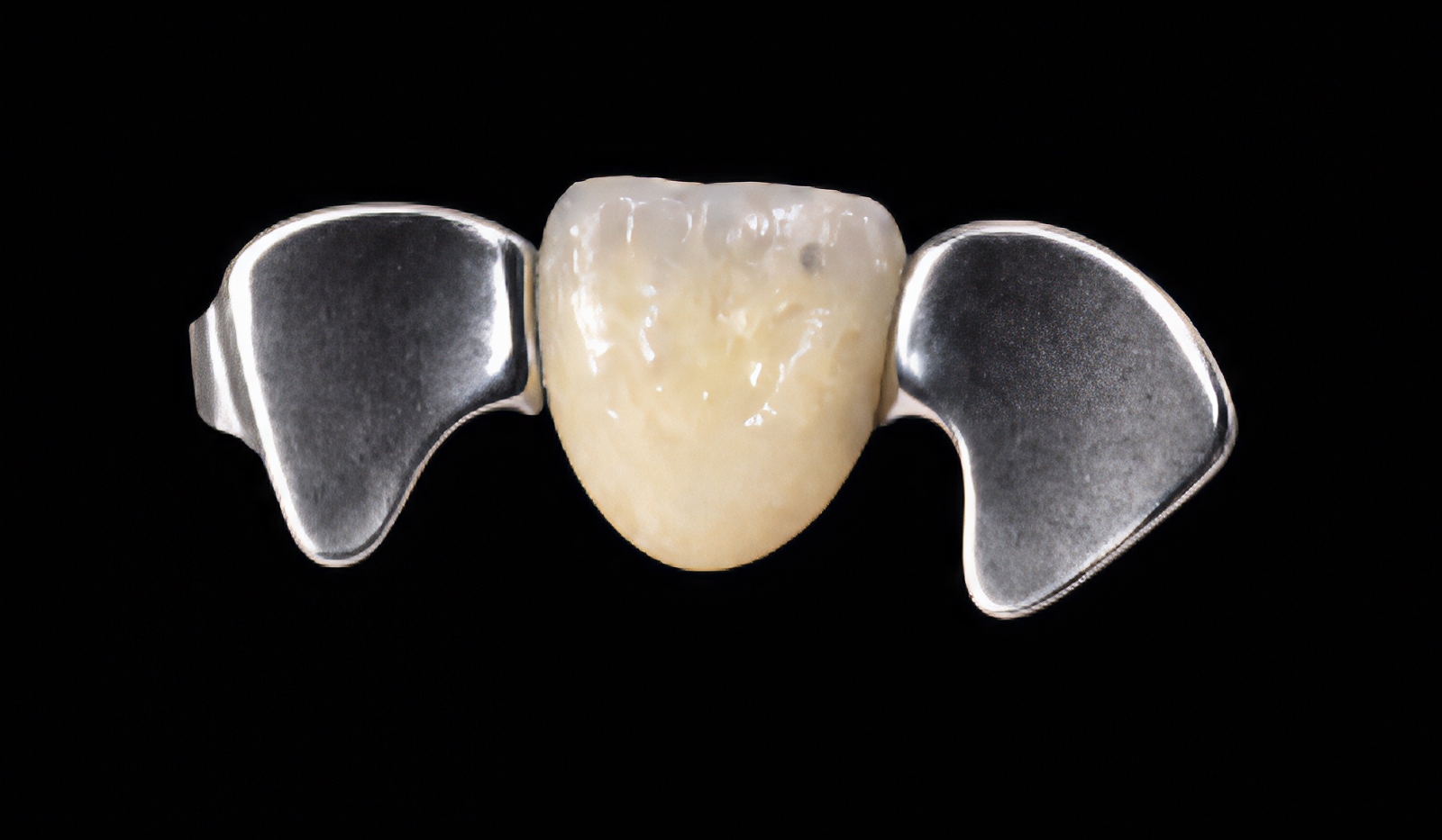 Maryland Bridge vs Implant: Single Tooth Replacement Options | by Andrew Sedler | Burbank Dental Lab