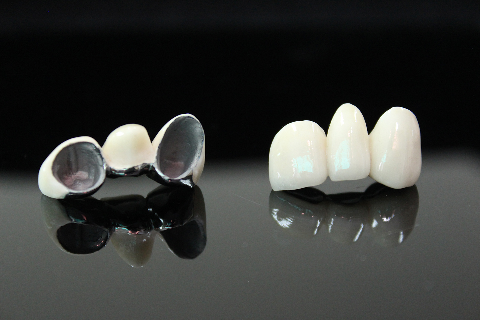Maryland Bridge vs Implant: Single Tooth Replacement Options | by Andrew Sedler | Burbank Dental Lab
