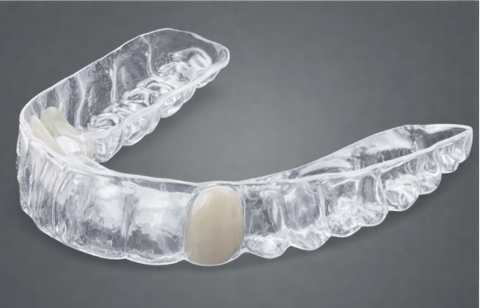 Maryland Bridge vs Implant: Single Tooth Replacement Options | by Andrew Sedler | Burbank Dental Lab