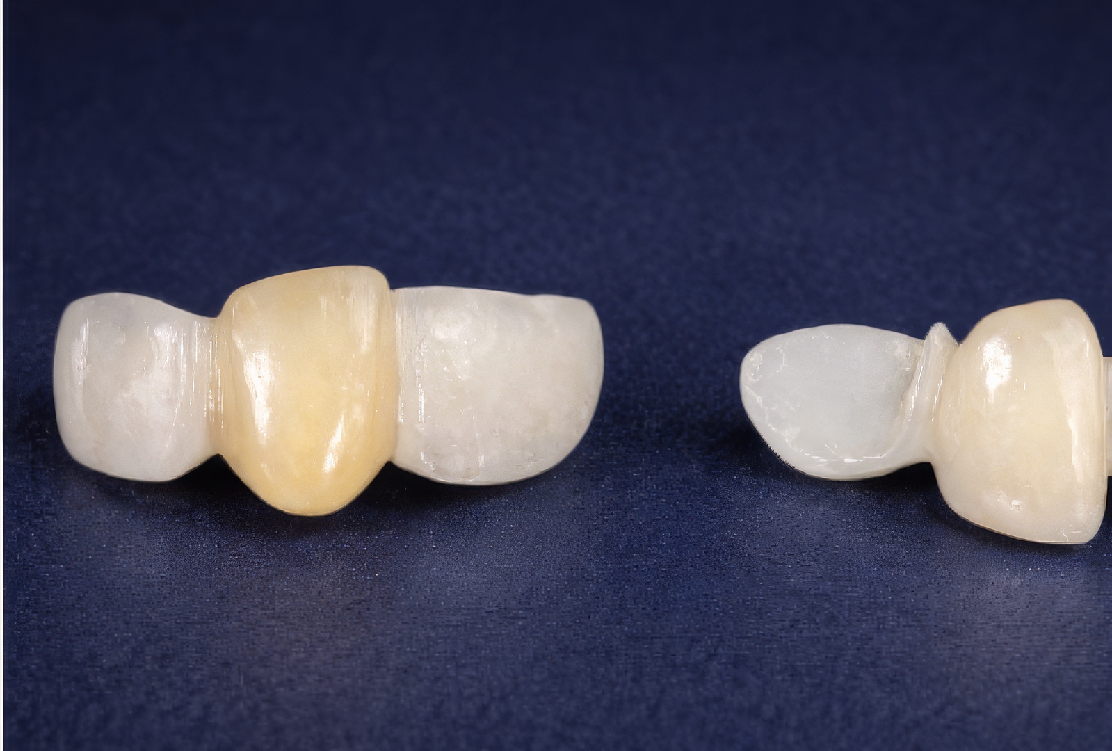 Maryland Bridge vs Implant: Single Tooth Replacement Options | by Andrew Sedler | Burbank Dental Lab