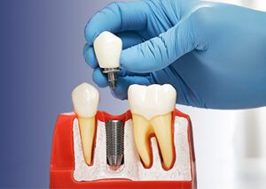 SMART 1 Dental Implant Options - Burbank Dental Lab - CA
