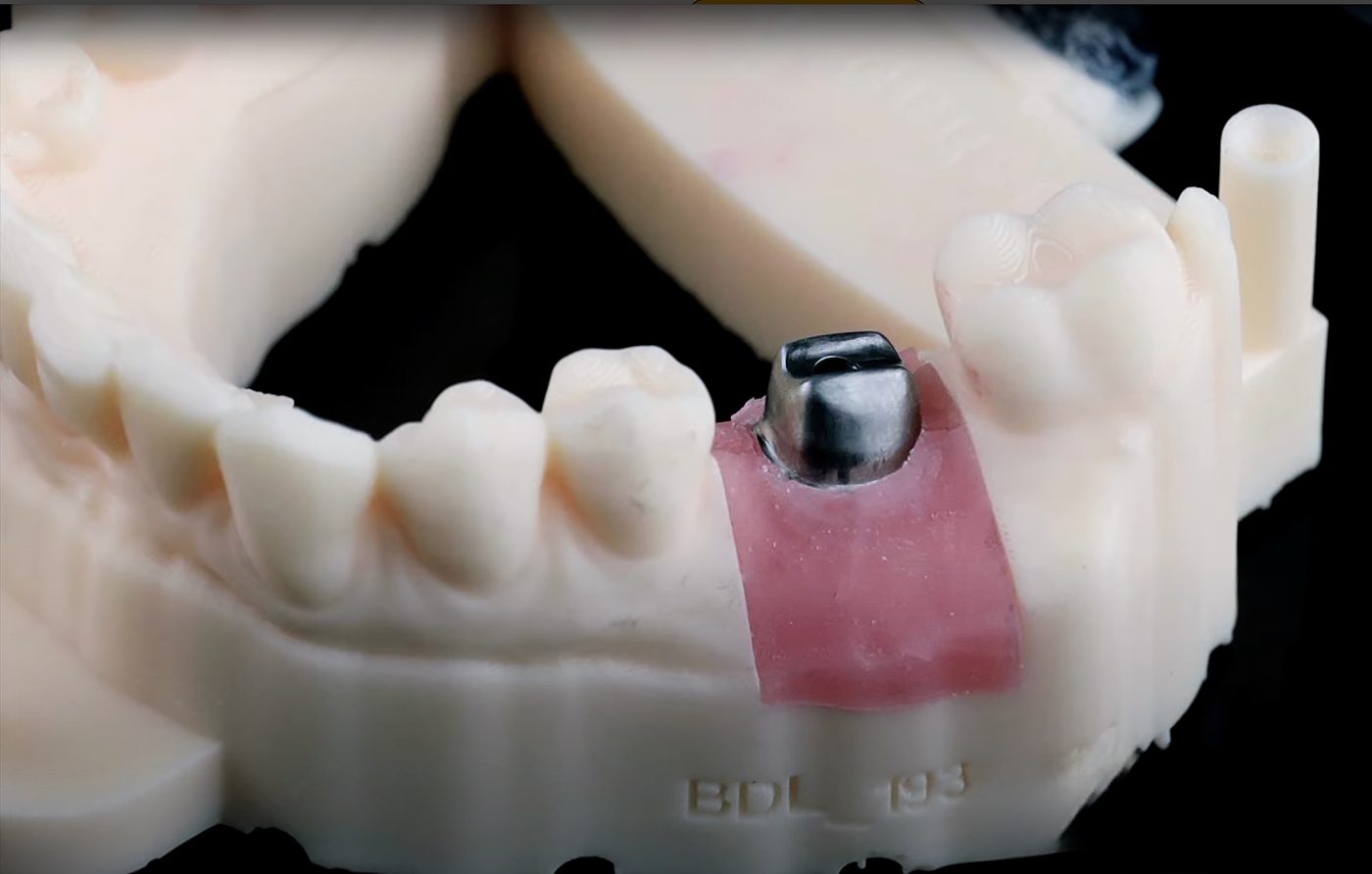 SMART 1 Implant Abutment - Burbank Dental Lab