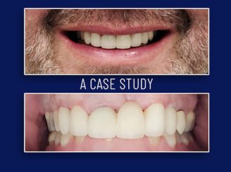 Treatment Planning for Complex Cases - by Andrew Sedler - Burbank Dental Lab - CA