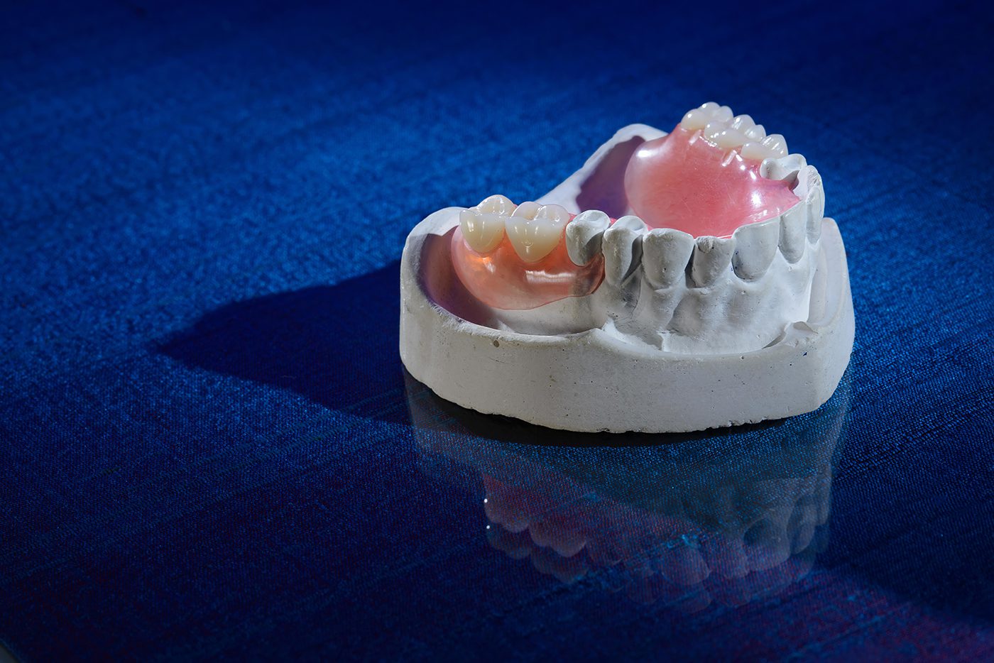 Valplast Partial Denture - Burbank Dental Lab - CA