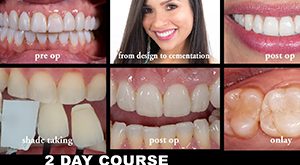 Veneers, Inlays, Onlays, and Vonlays - Dr. Ed McLaren