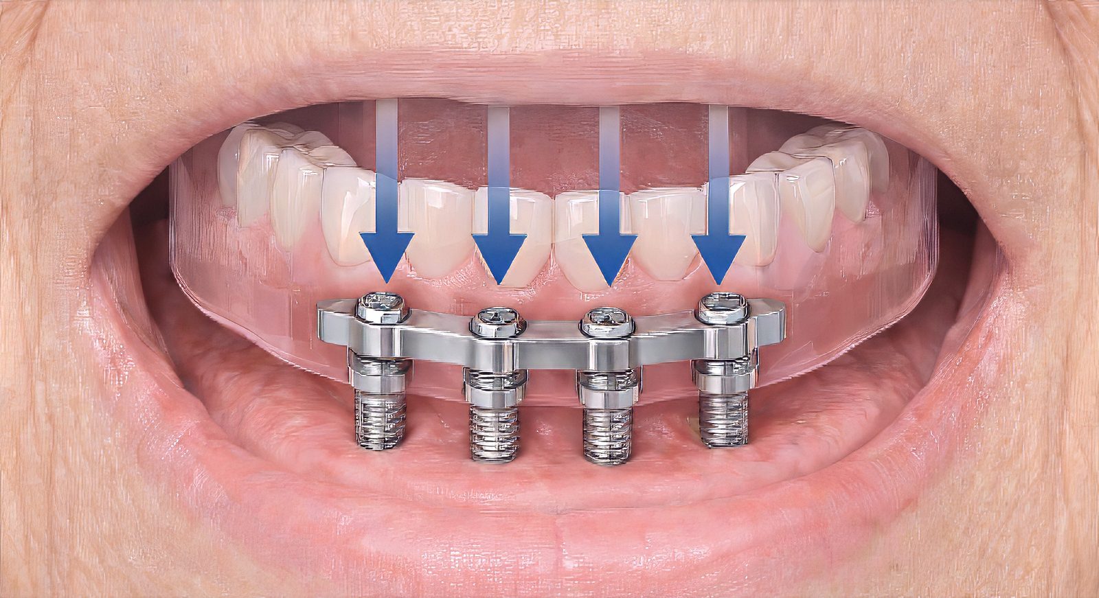 Burbank Dental Lab locator bar for denture over implant