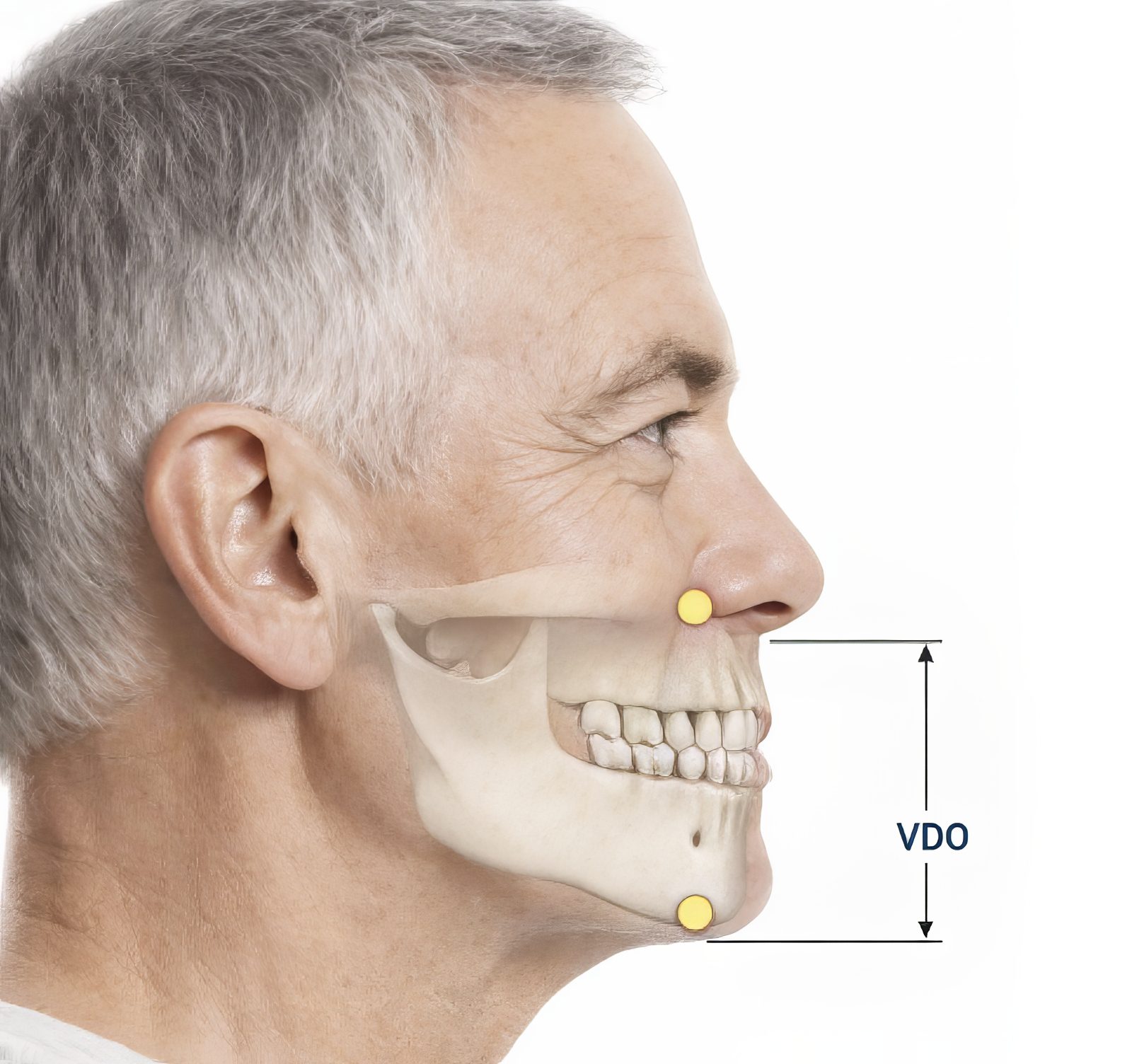 Ivoclar Digital Denture Workflow: A Dentist Focused Guide - Burbank Dental Lab - CA