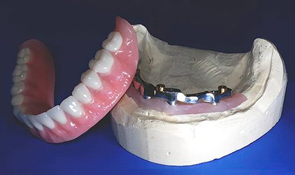 When to Choose an Implant Bar-Supported Overdenture - by Andrew Sedler, COO - Burbank Dental Lab - CA