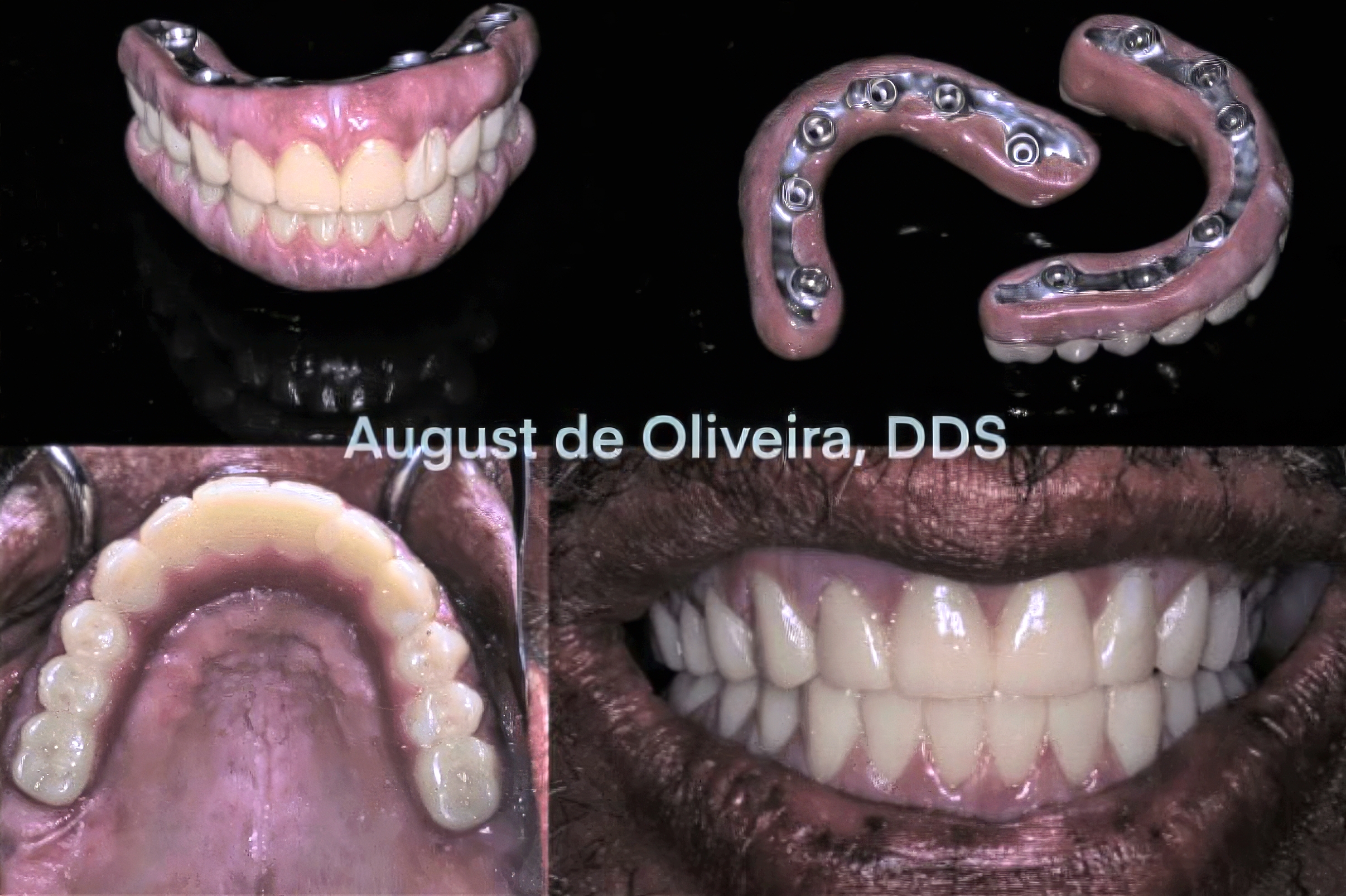 Why PMMA Hybrid Prostheses Are the Smarter Choice for High-Risk Full-Arch Implant Patients | Burbank Dental Lab