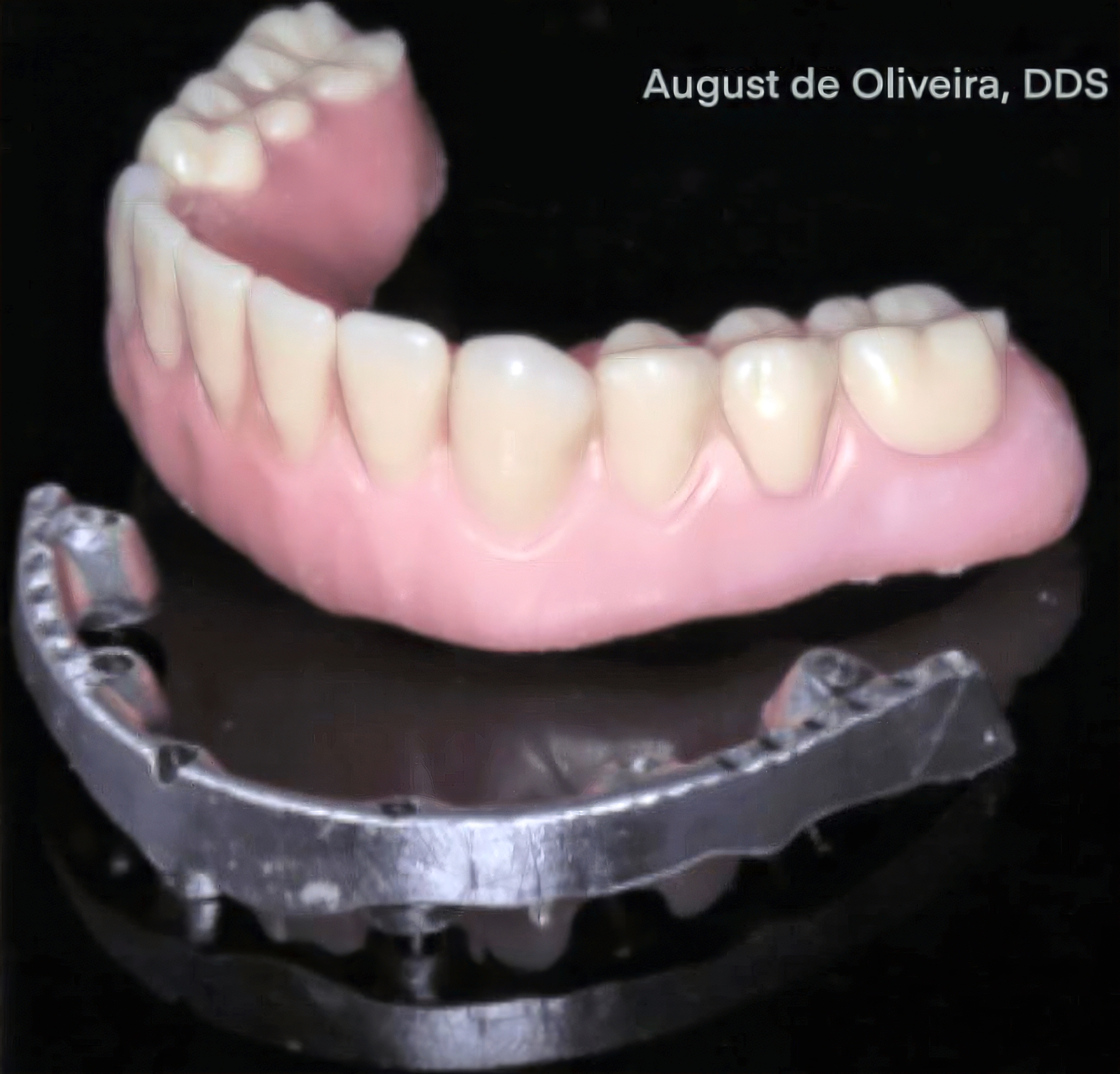 Why PMMA Hybrid Prostheses Are the Smarter Choice for High-Risk Full-Arch Implant Patients | Burbank Dental Lab