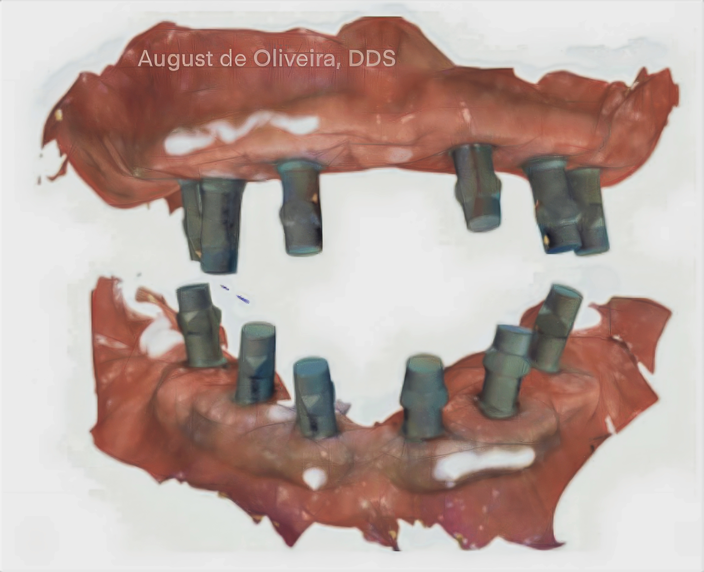 Why PMMA Hybrid Prostheses Are the Smarter Choice for High-Risk Full-Arch Implant Patients | Burbank Dental Lab