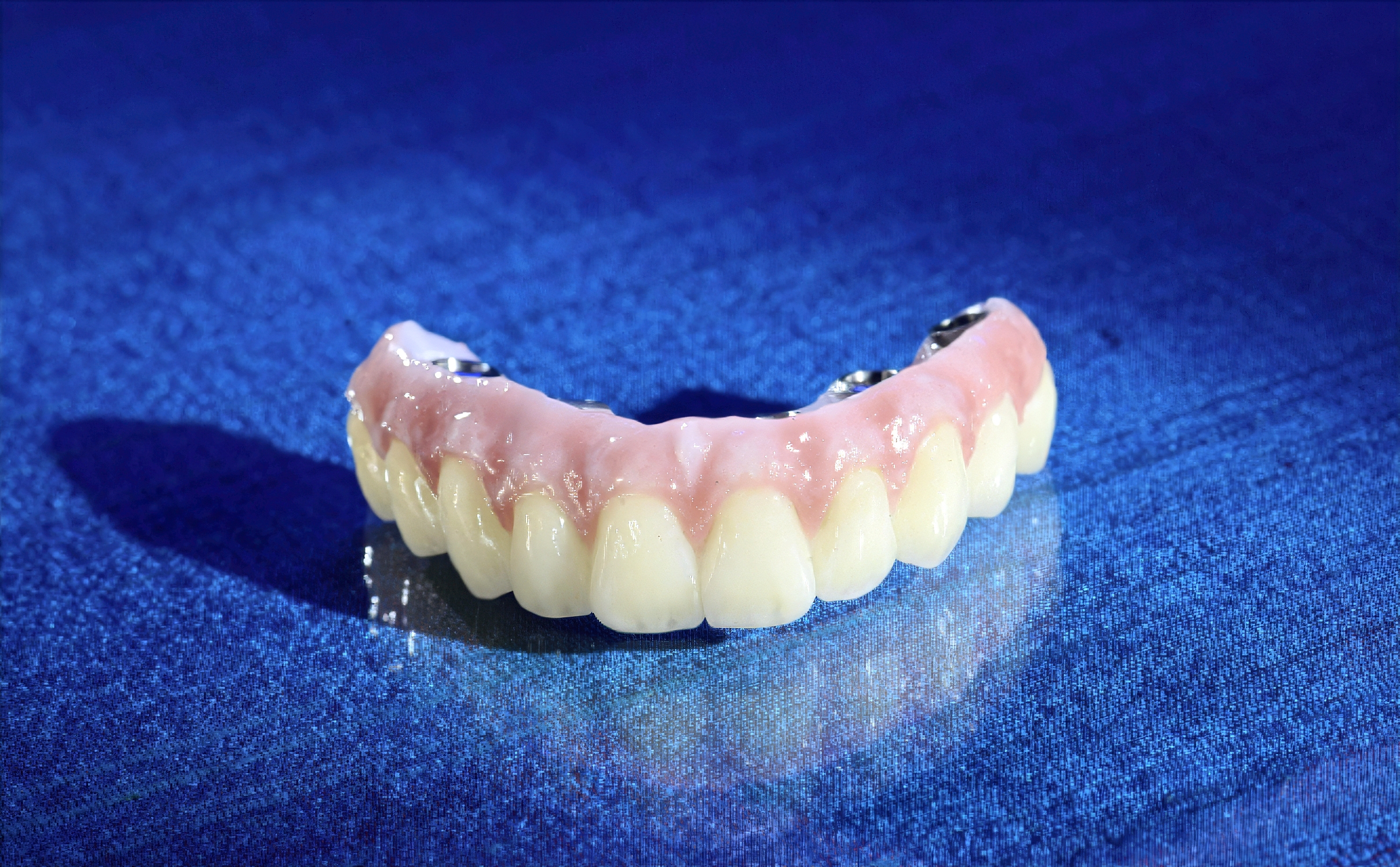 Why PMMA Hybrid Prostheses Are the Smarter Choice for High-Risk Full-Arch Implant Patients | Burbank Dental Lab