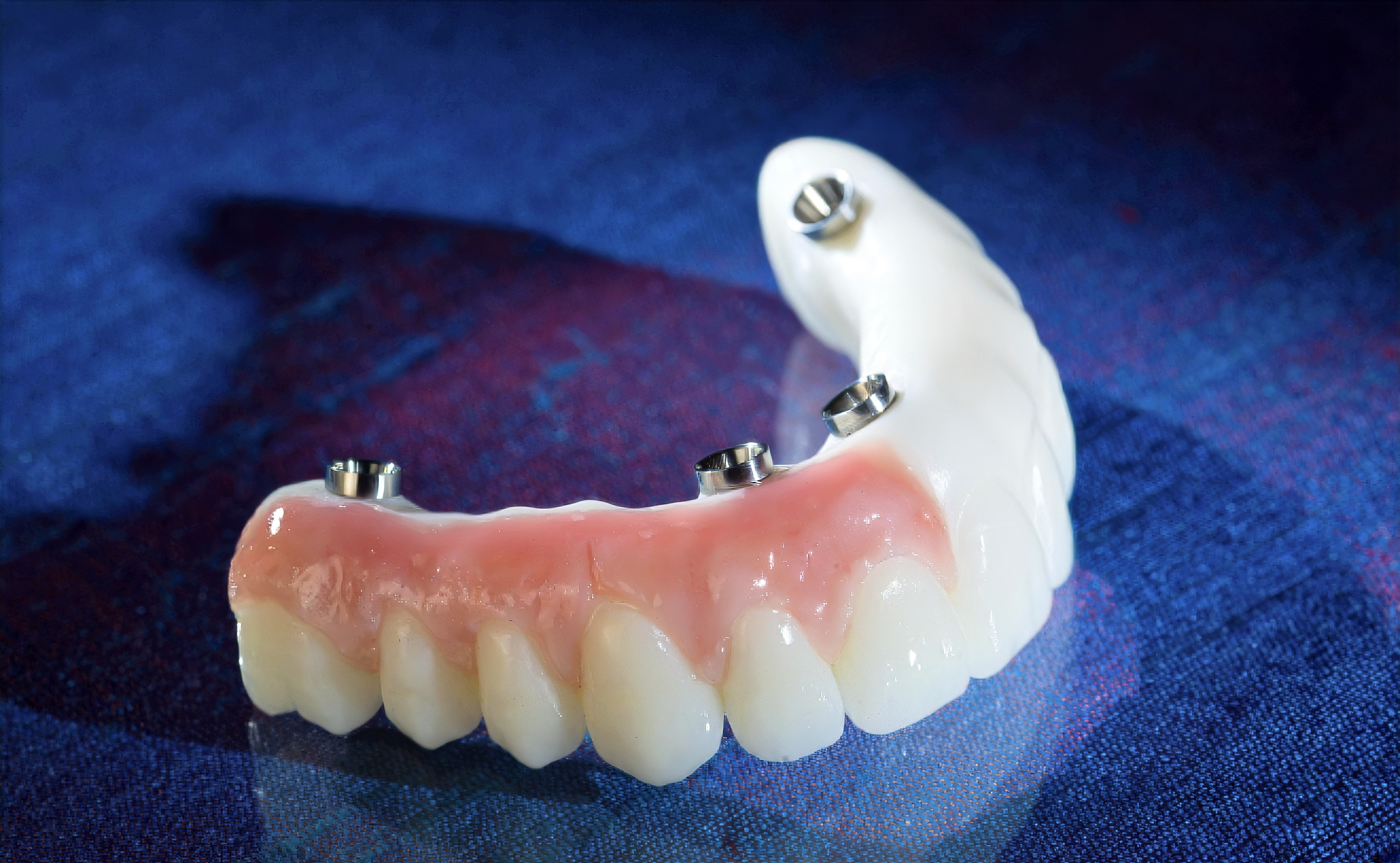 Why PMMA Hybrid Prostheses Are the Smarter Choice for High-Risk Full-Arch Implant Patients | Burbank Dental Lab