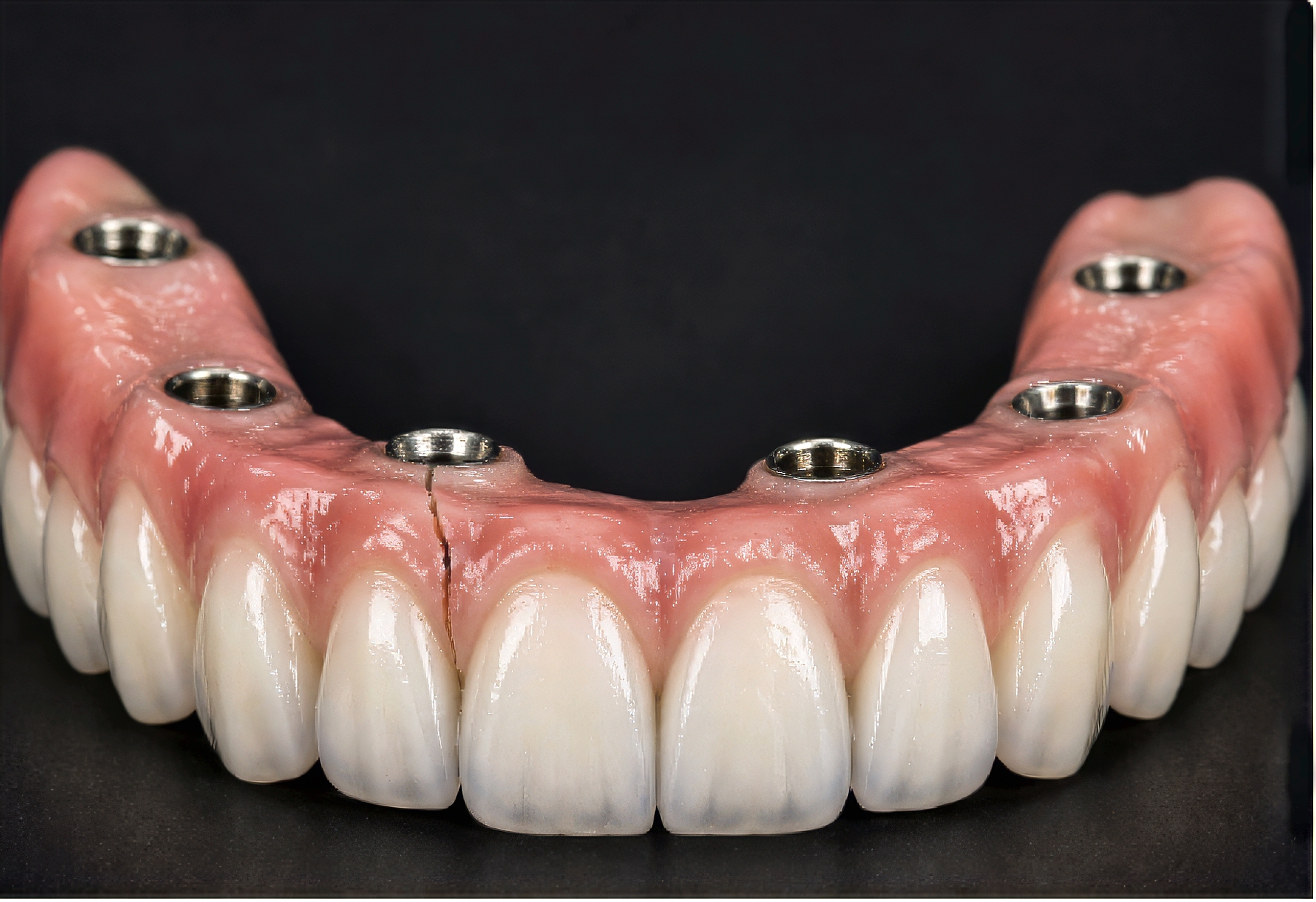 Why PMMA Hybrid Prostheses Are the Smarter Choice for High-Risk Full-Arch Implant Patients  |  Burbank Dental Lab