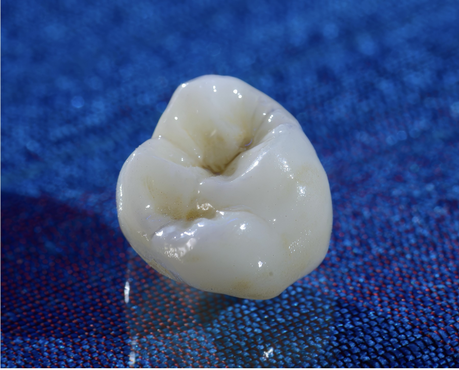 Zirconia vs. Lithium Disilicate: How to Choose the Right Crown Material | by Andrew Sedler, COO | Burbank Dental Lab