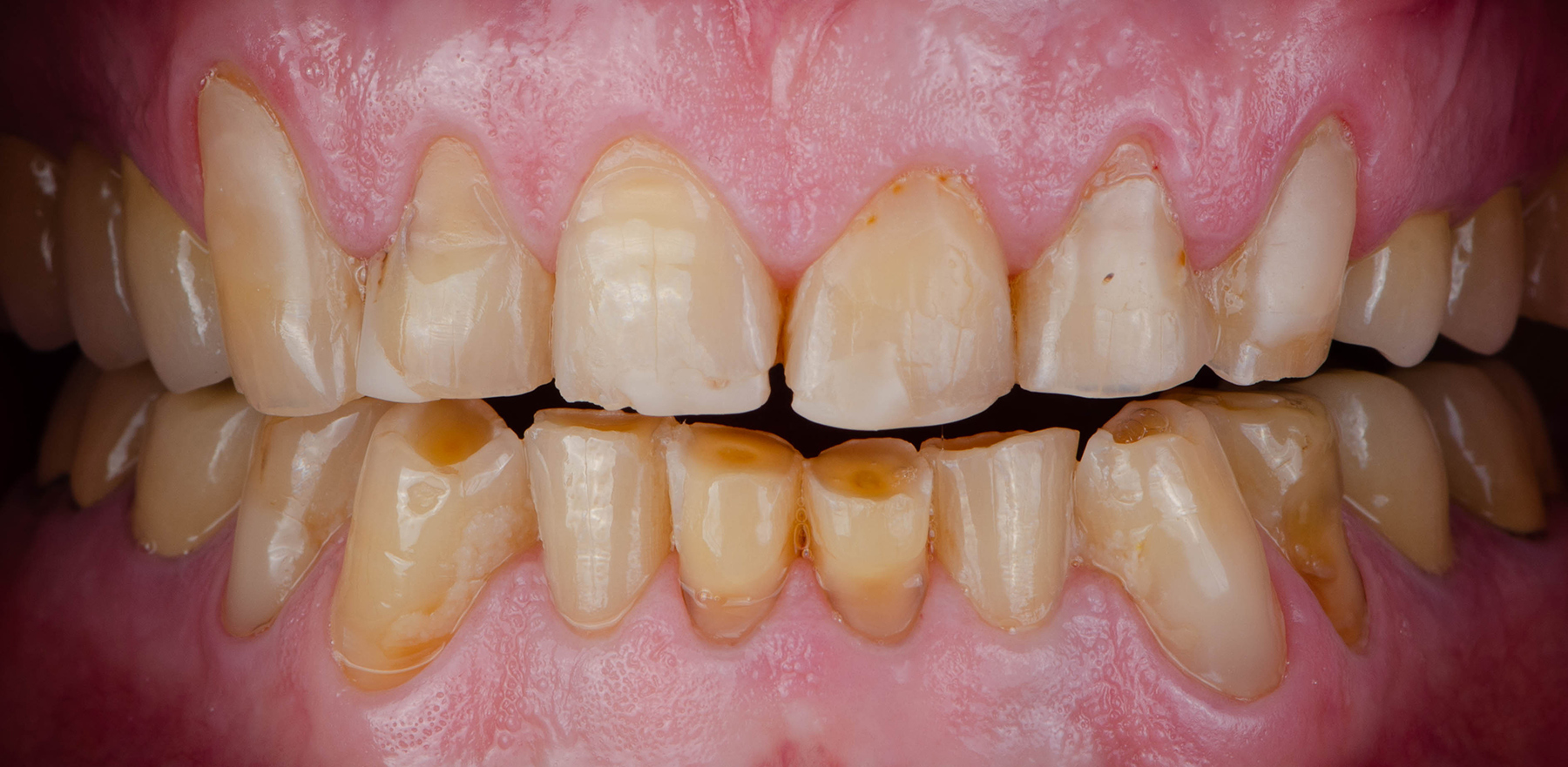 Zirconia vs. Lithium Disilicate: How to Choose the Right Crown Material | by Andrew Sedler, COO | Burbank Dental Lab