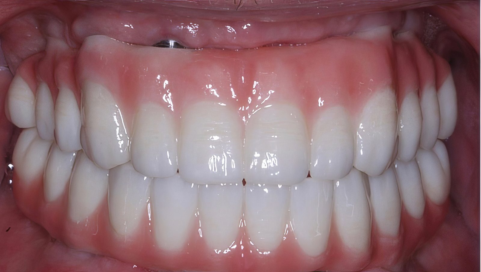 ZIRMAX M Hybrid - Burbank Dental Lab - California