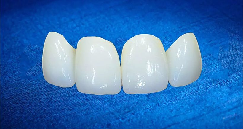 Multi-Unit Abutments: When and How To Use Them
