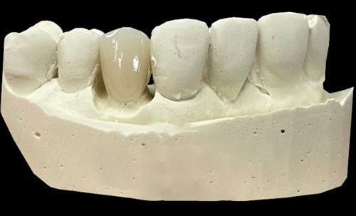 ZIRMAX ME: The Modern Zirconia Solution for Dentists Who Demand More - Burbank Dental Lab