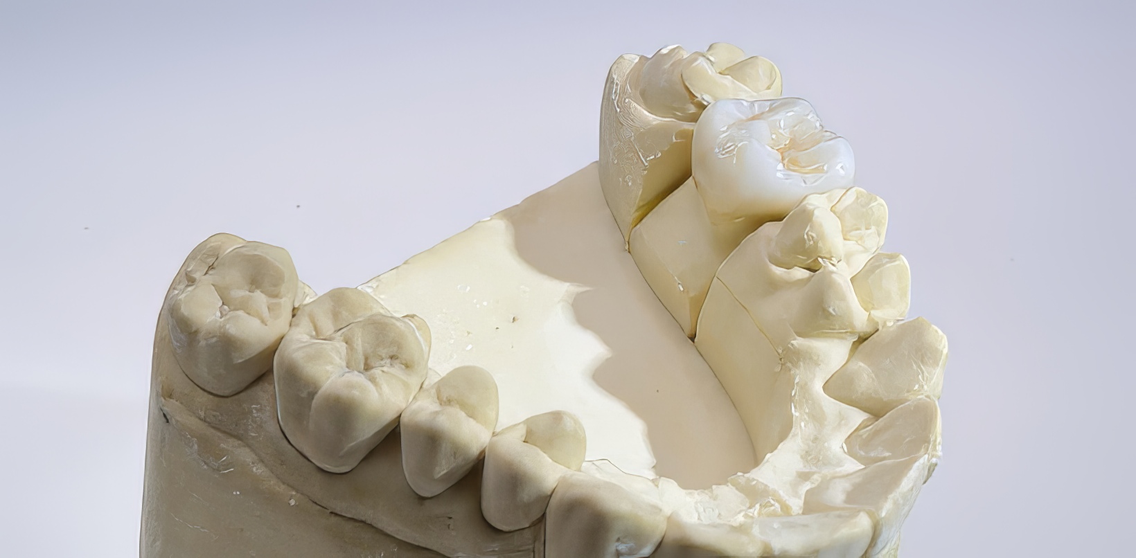 Multi-Unit Abutments: When and How To Use Them